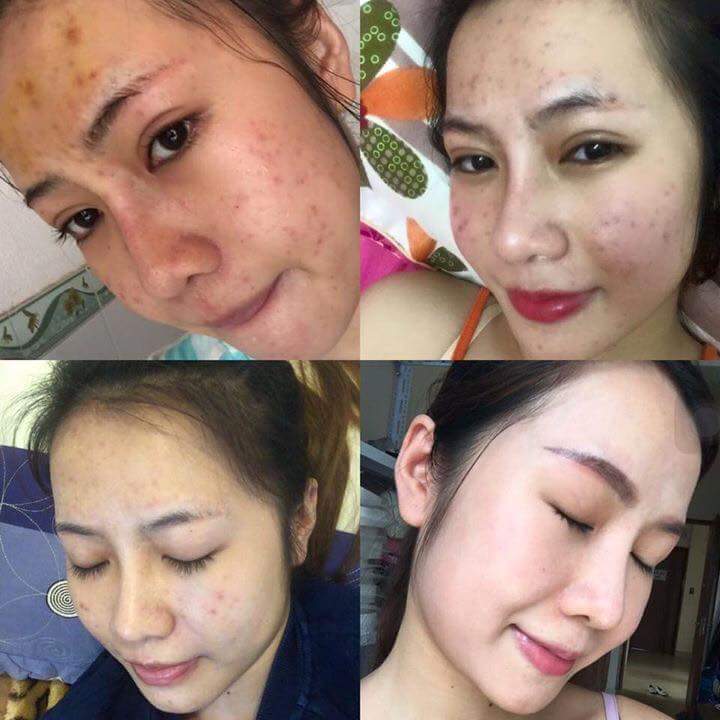 Kem trị mụn, làm mờ vết thâm, dưỡng trắng da Mother Care Giá bán: 0đ