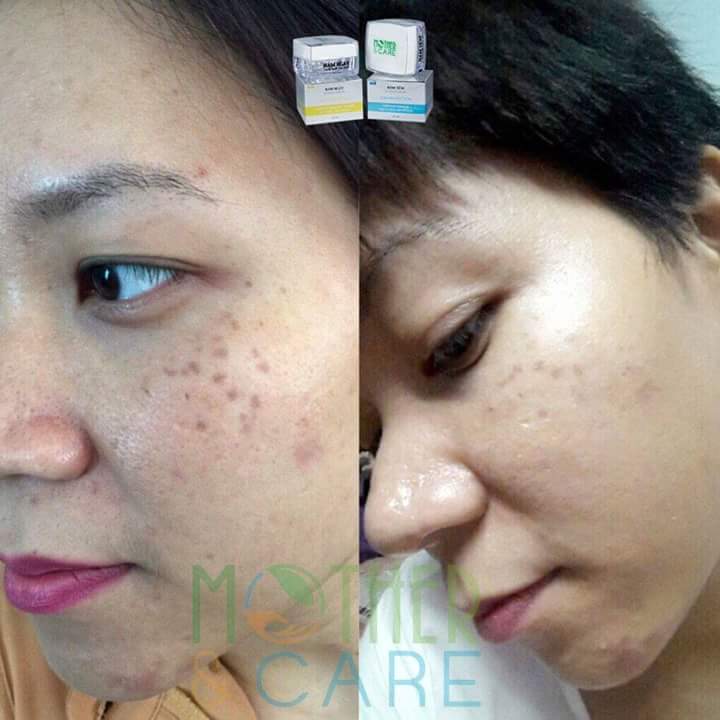 COMBO NÁM NGÀY ĐÊM MOTHER & CARE Giá bán: 0đ