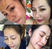 Kem trị mụn, làm mờ vết thâm, dưỡng trắng da Mother Care