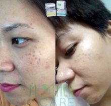 COMBO NÁM NGÀY ĐÊM MOTHER & CARE